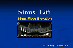 MLCT優質講師-周建堂-Sinus Lift