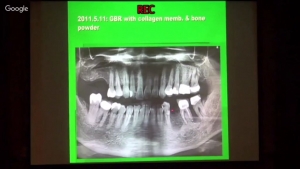 ImplantT0088001呂睿庭-案例分享